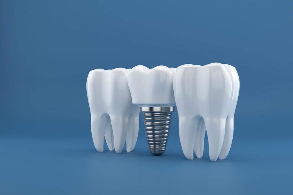 Dental Crowns & Bridges in Manchester | Moston Dental Practice