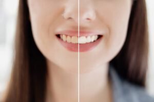 Teeth Whitening Damage Enamel