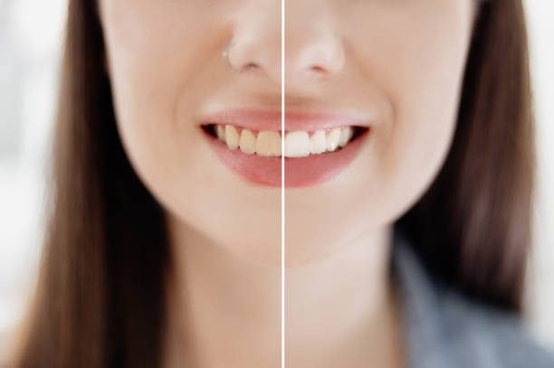 Teeth Whitening Damage Enamel