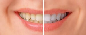 Does Composite Bonding Whiten Teeth?