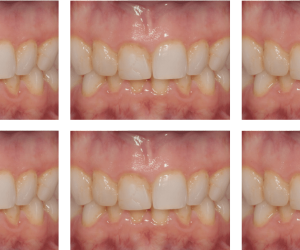 Invisalign treatment