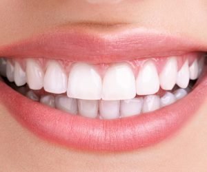 Invisalign